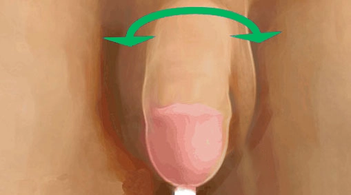 Depois do procedimento